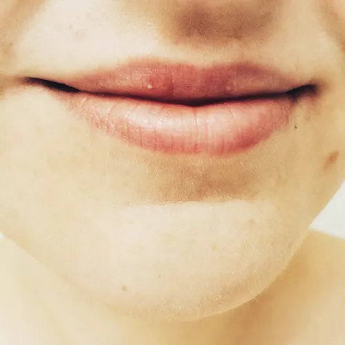 A whitehead in the middle of my upper lip - first time I've had one of these by Nekou