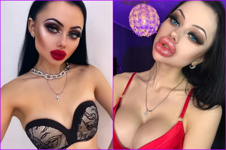 It took only one year to make breast implants, lips and chin Proud of myself by Fine-Ad2329