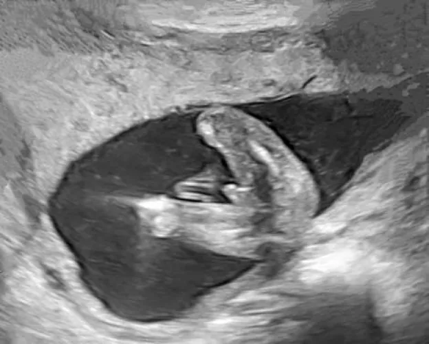 Update from the couple I helped conceive: It's a boy (again) by WorldBreeder