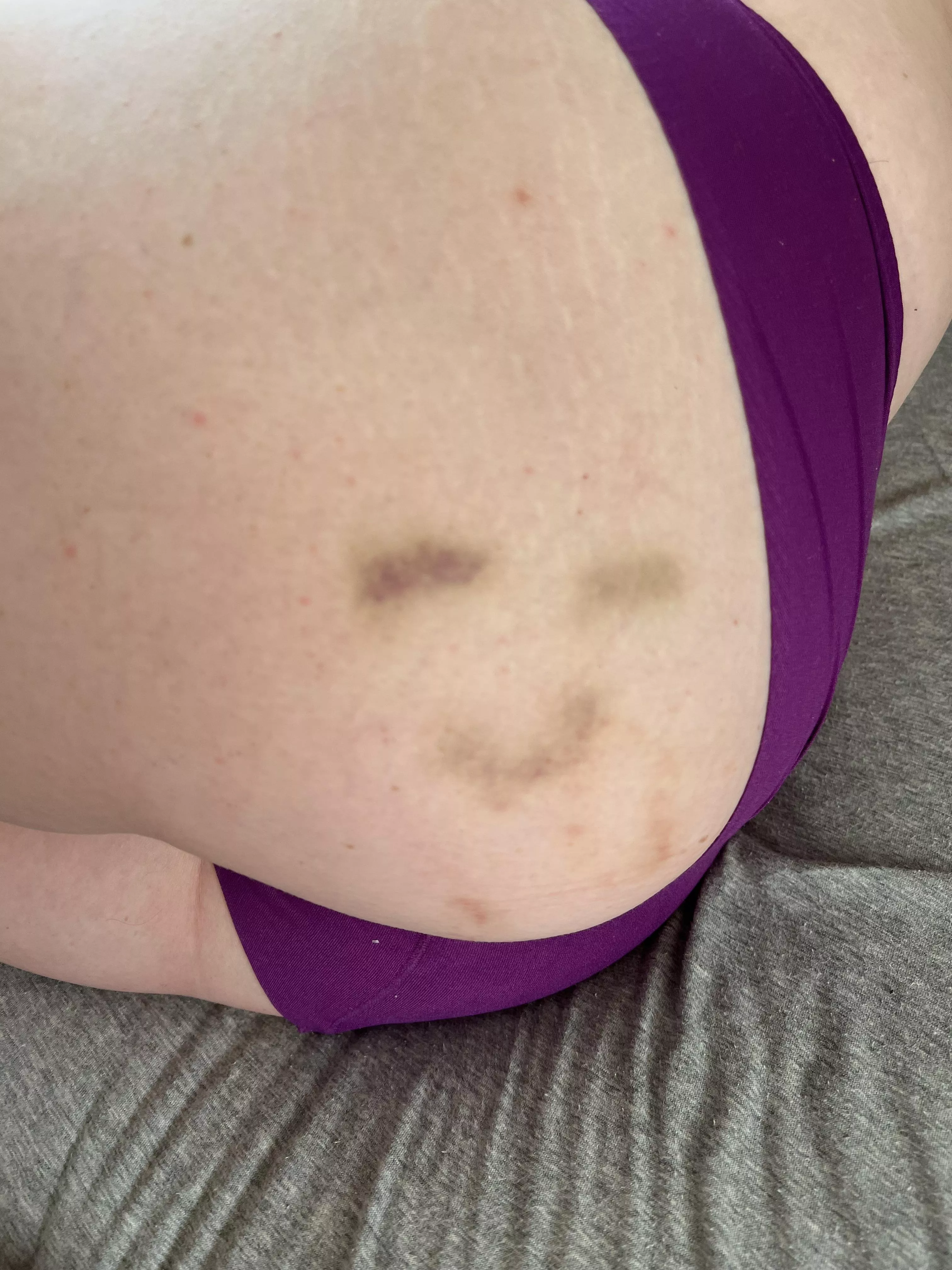 My bruises are happy to be here ☺️ posted by bunnyprince1913