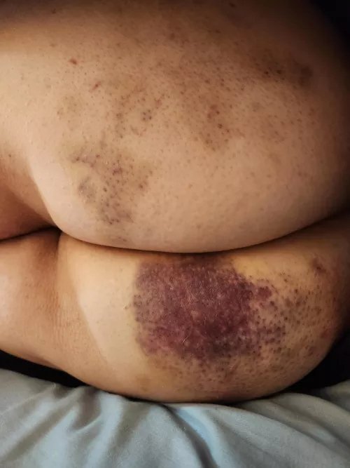 Flogged hard in front of everyone at the club this past weekend! 🥰 by SeductiveLittle97