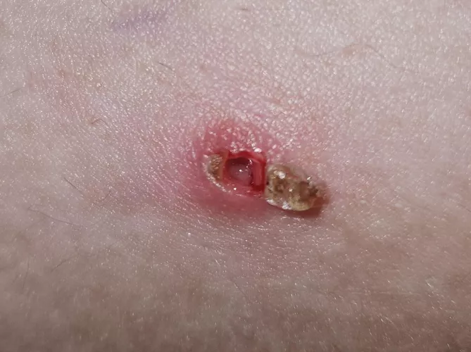 Partner's deep armpit pimple finally popped by geierhexe
