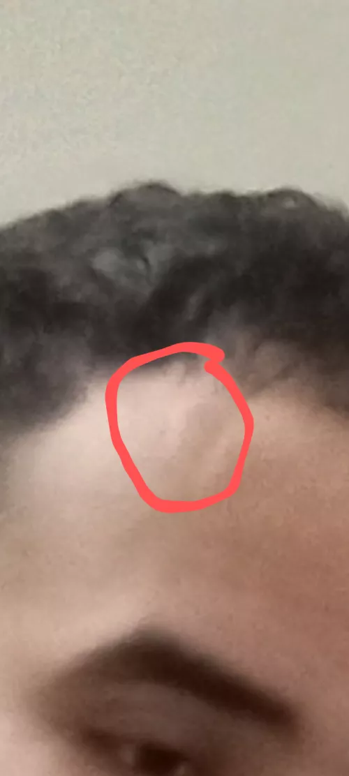 Bump on forehead for years not sure what it is by bigballerjay