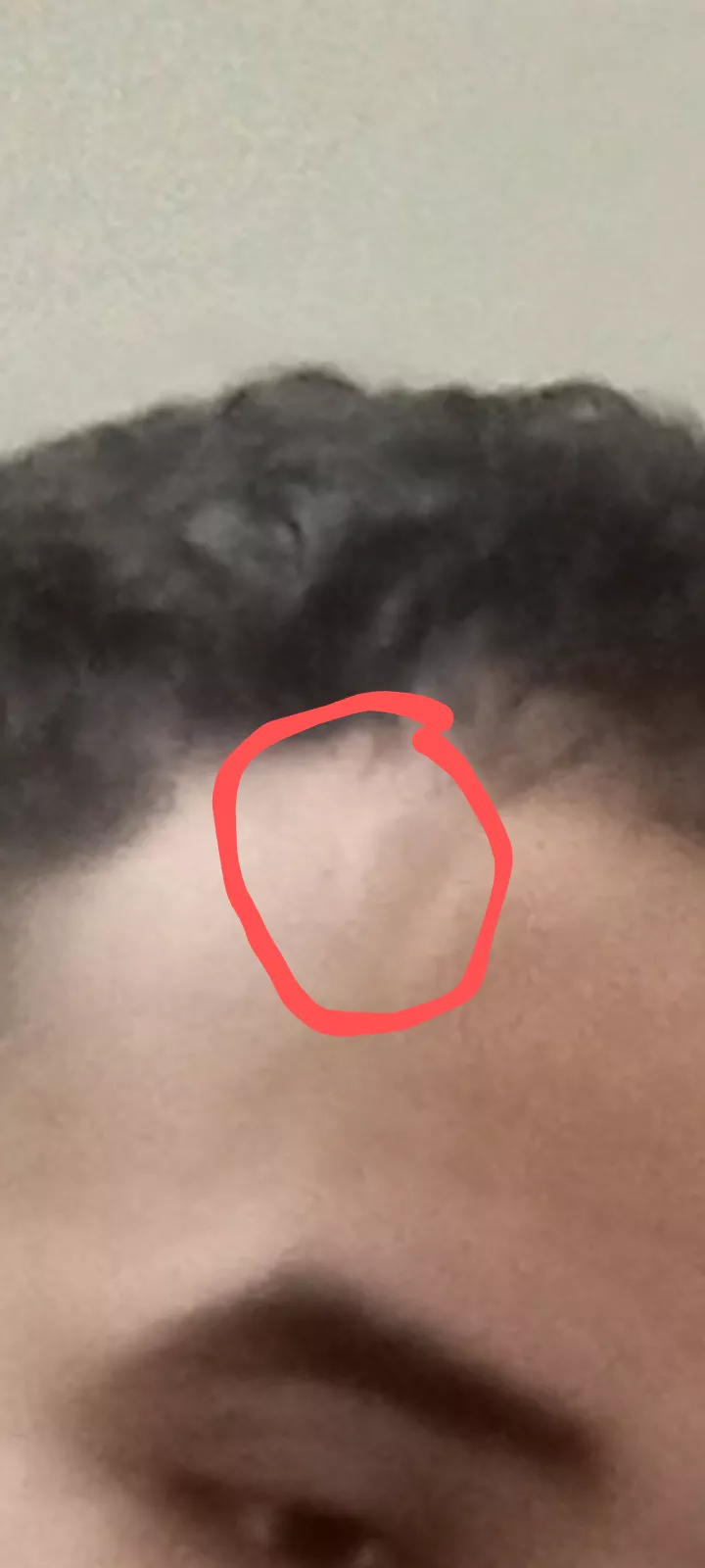 Bump on forehead for years not sure what it is posted by bigballerjay