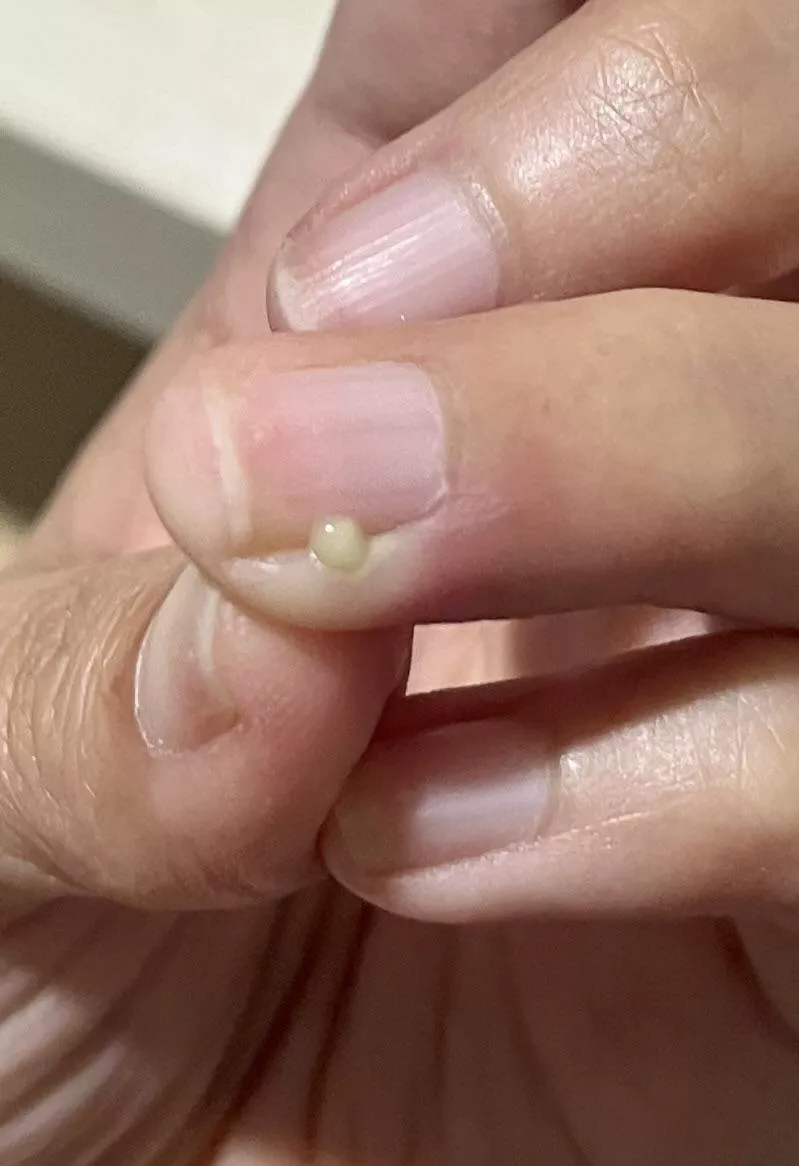 Used a (sterilised) needle to pop and it felt nice posted by misty_throwaway