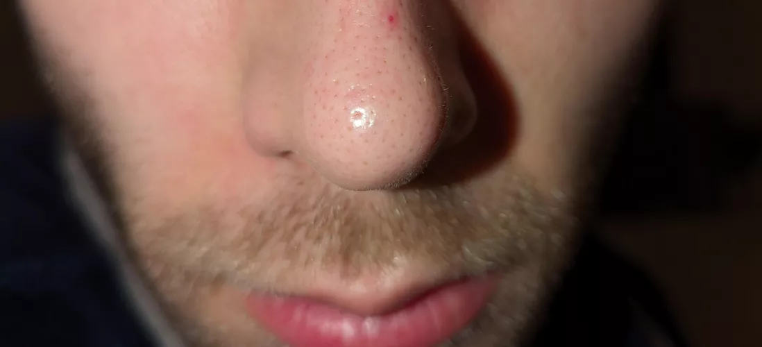I've had this red dot on my nose for a year after having a pimple there. What is it? by MTGTraner