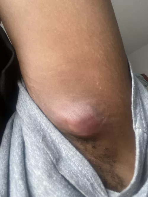 Armpit abscess - named it Parry by shaplavela