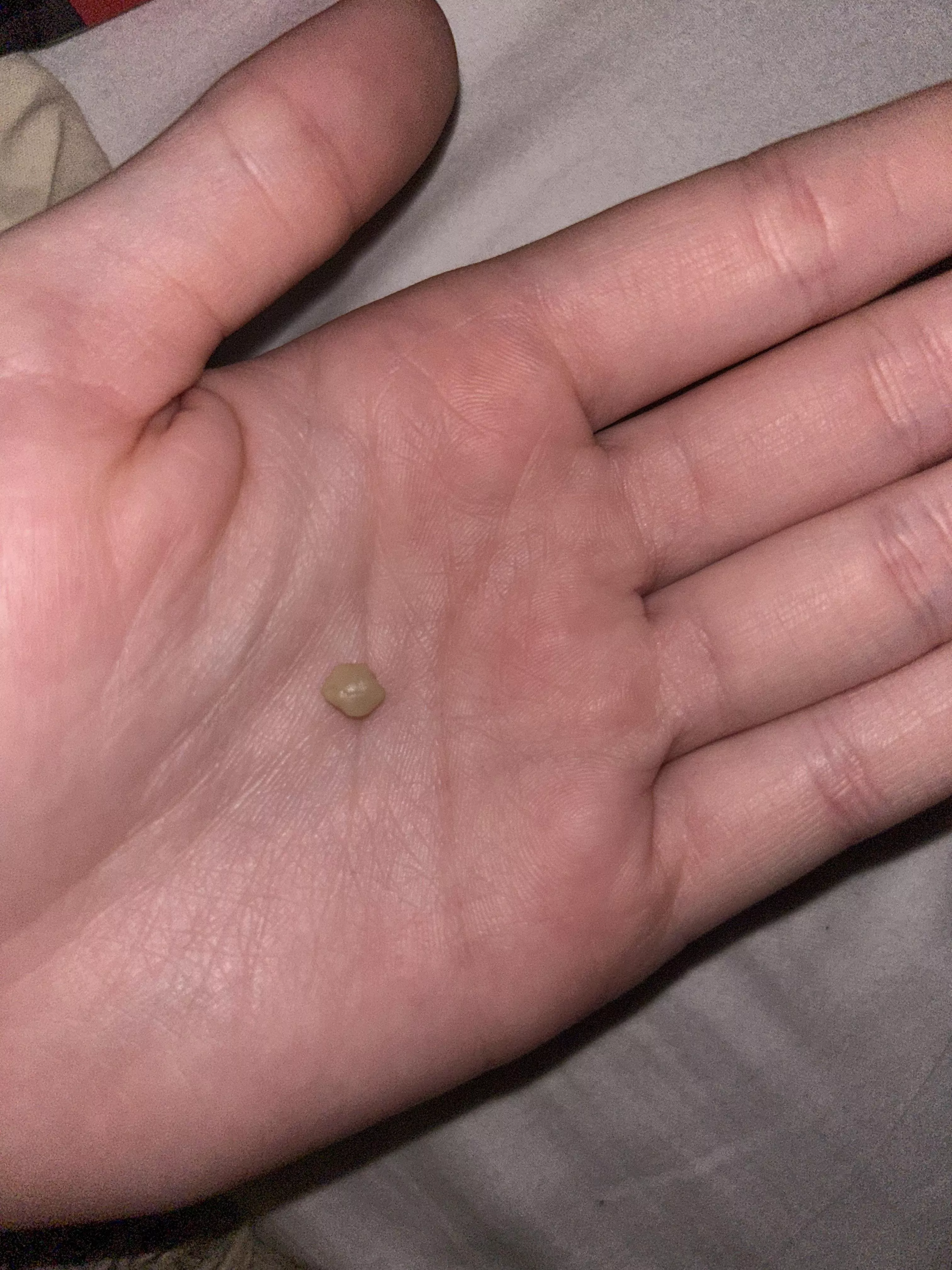 got the biggest tonsil stone i’ve ever gotten posted by bisexualwhore
