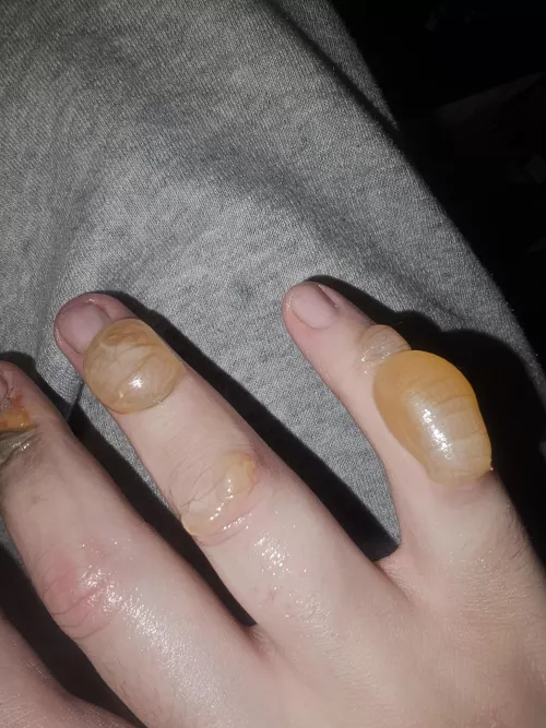 Have been told to avoid popping these, my urges have never been greater though 😭 by darthjammer224