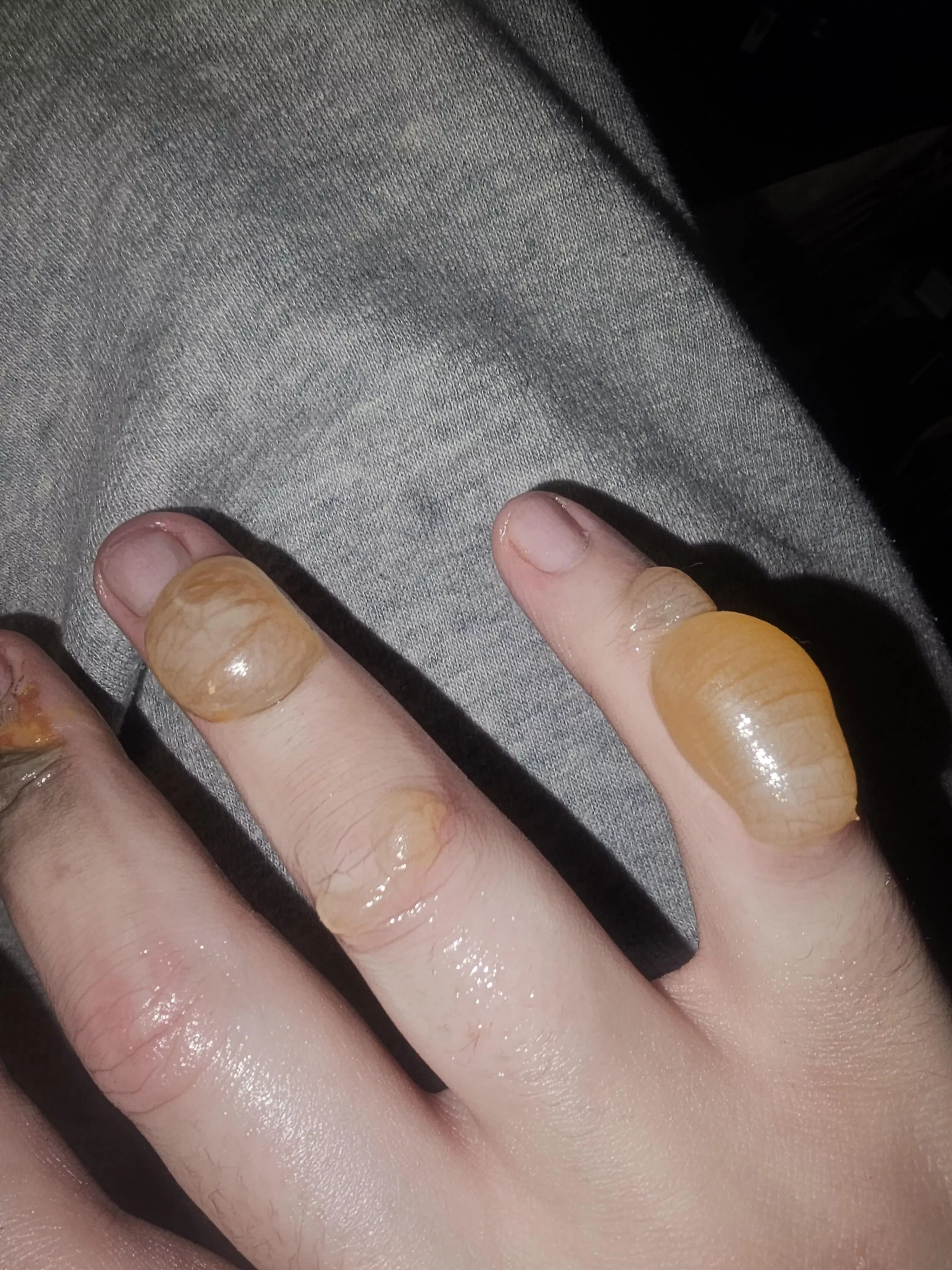 Have been told to avoid popping these, my urges have never been greater though 😭 posted by darthjammer224