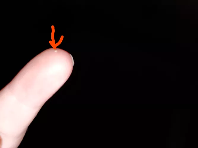 Really gross keratin plug I popped out of my forehead by TheQueen_Of-Vore