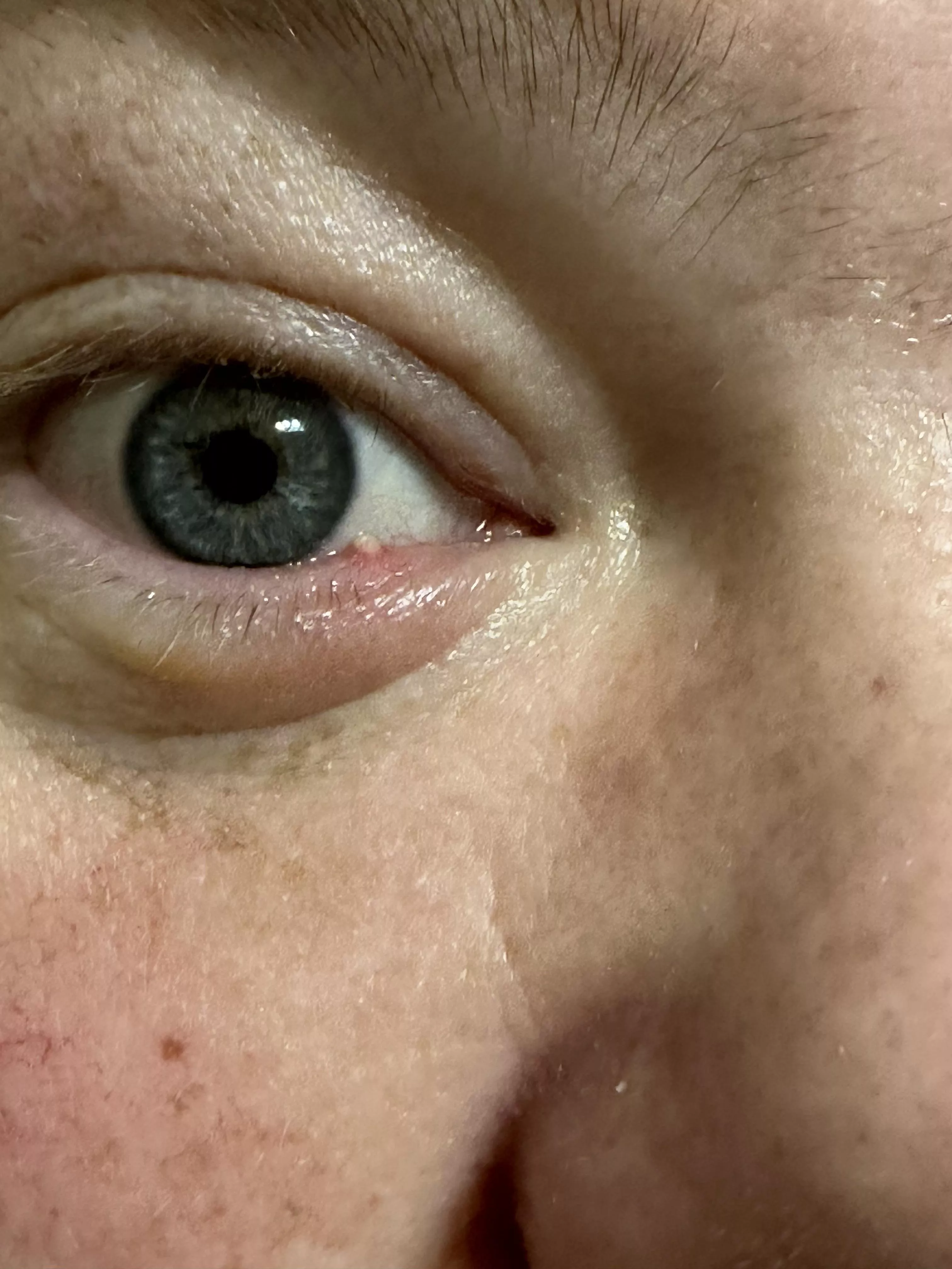 Hubby’s stye is coming to head posted by Pappymommy