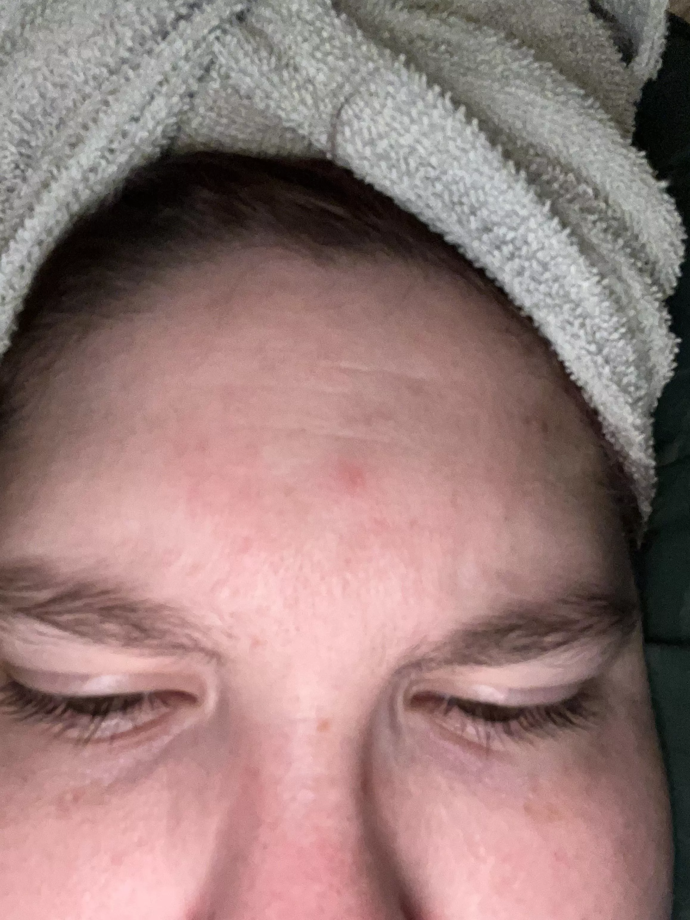 I’m getting married Sunday so of course I develop a pimple right in the middle of my forehead and of course I scratch it in my sleep and make it even more irritated🙃 posted by KaylaRocksss