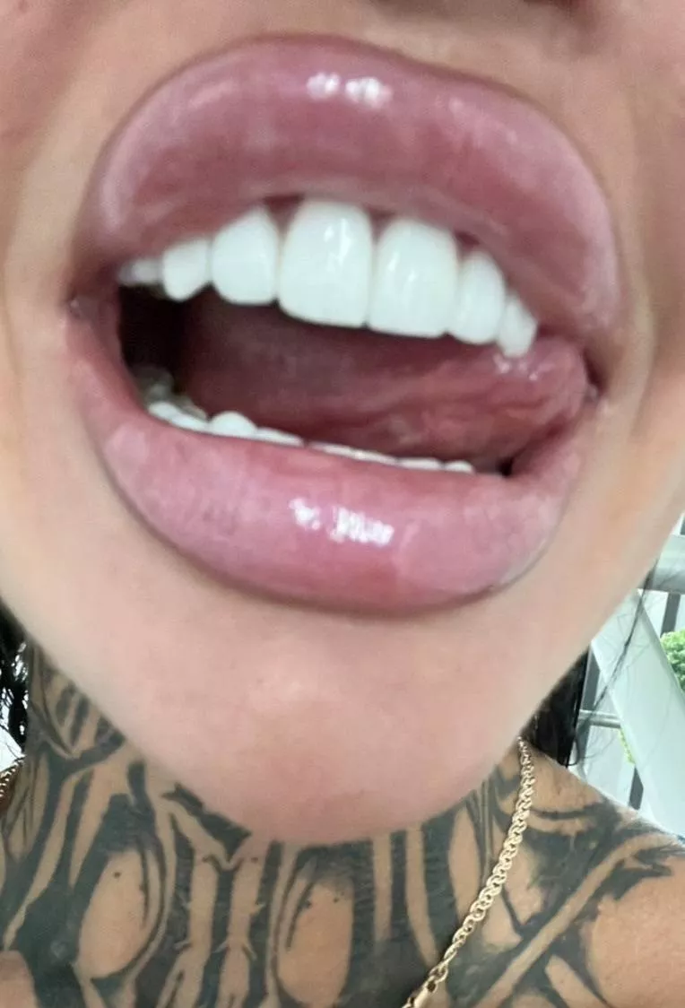 My freshly filled lips posted by coedolsz