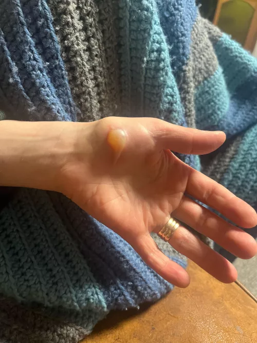 Forbidden pop from a burn. by Important_Tart_4160