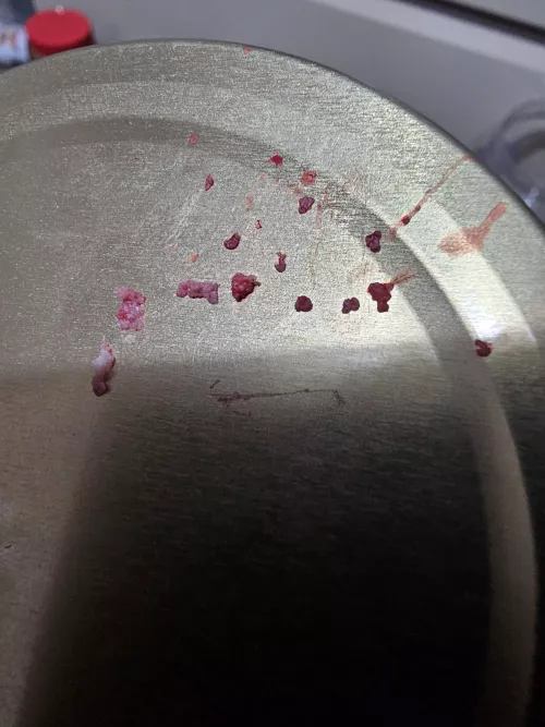 Aftermath of a pimple by OddOctopoda