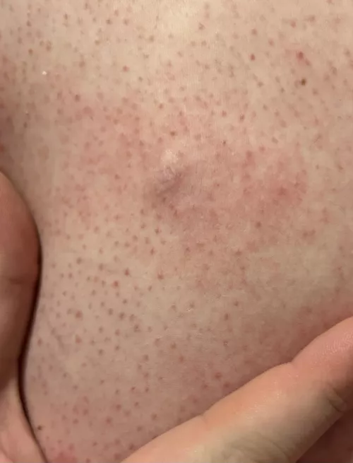 Just rolled over in bed and this little guy I’ve had for years just popped on his own. Popped under the skin though, not used to that one by lazy-doggo-man