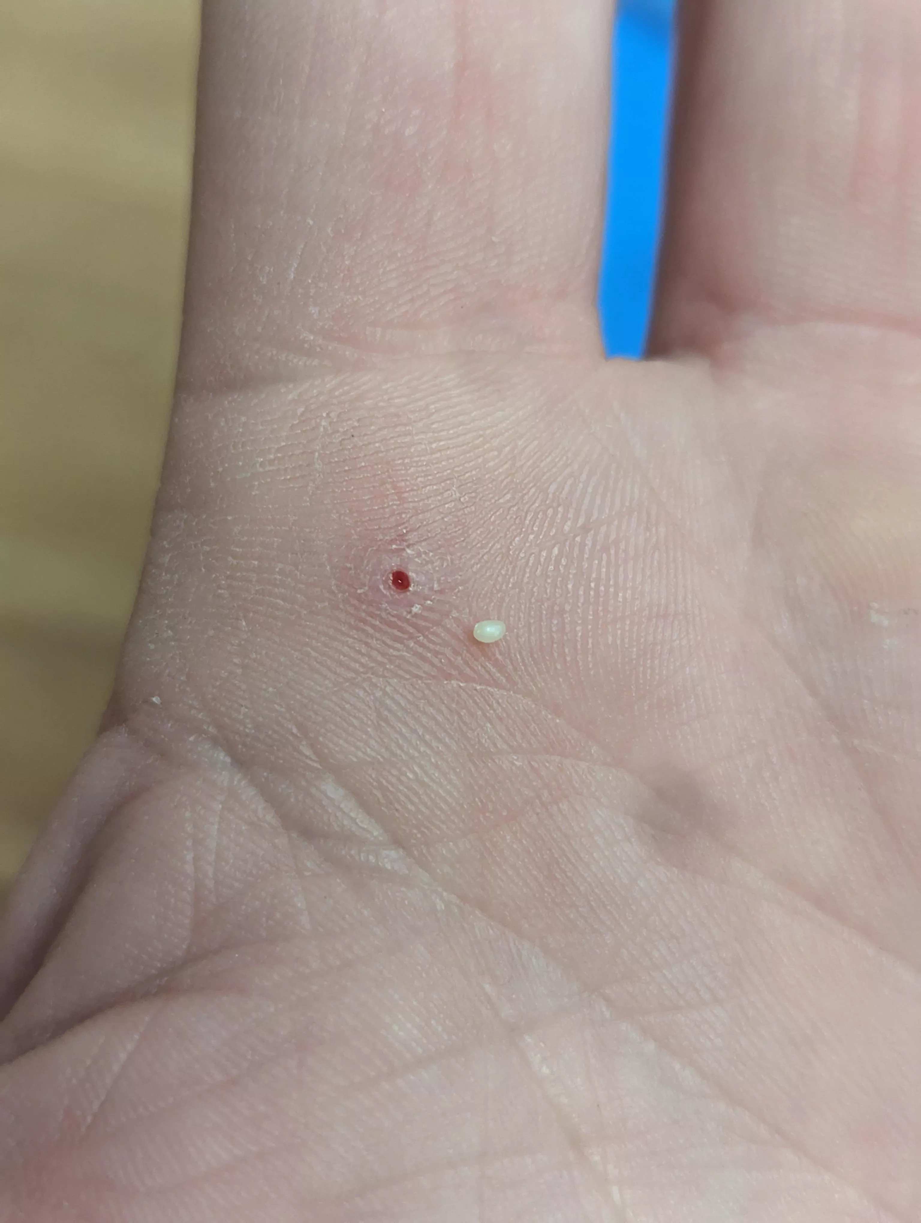 Thought I had a splinter, but this little guy came out instead. It's hard like a rock. posted by jkimbrell
