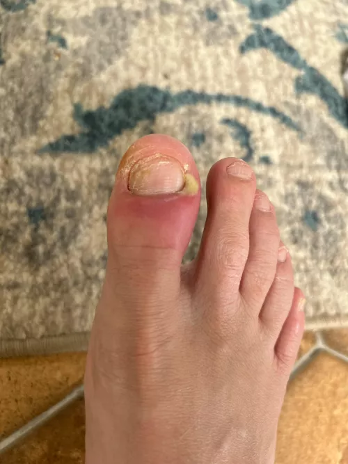 Brutal toe pop Coming up by eatBuGsandPlaNtS
