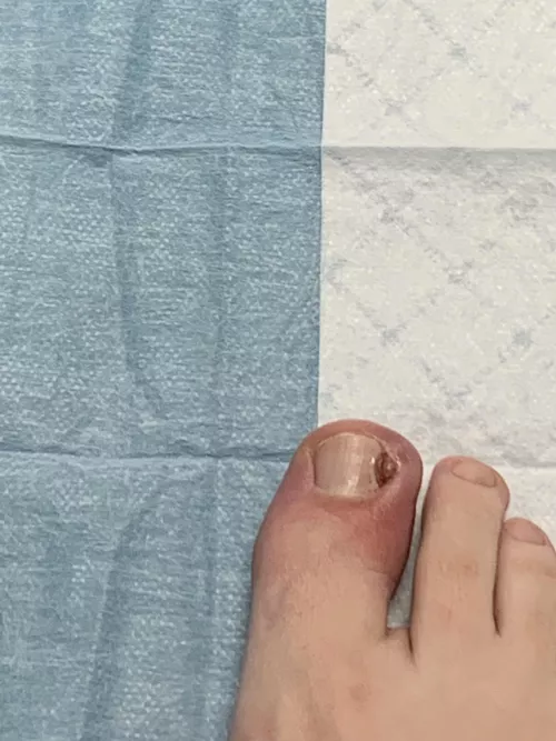 Ingrown toenail with staph by shayaceleste