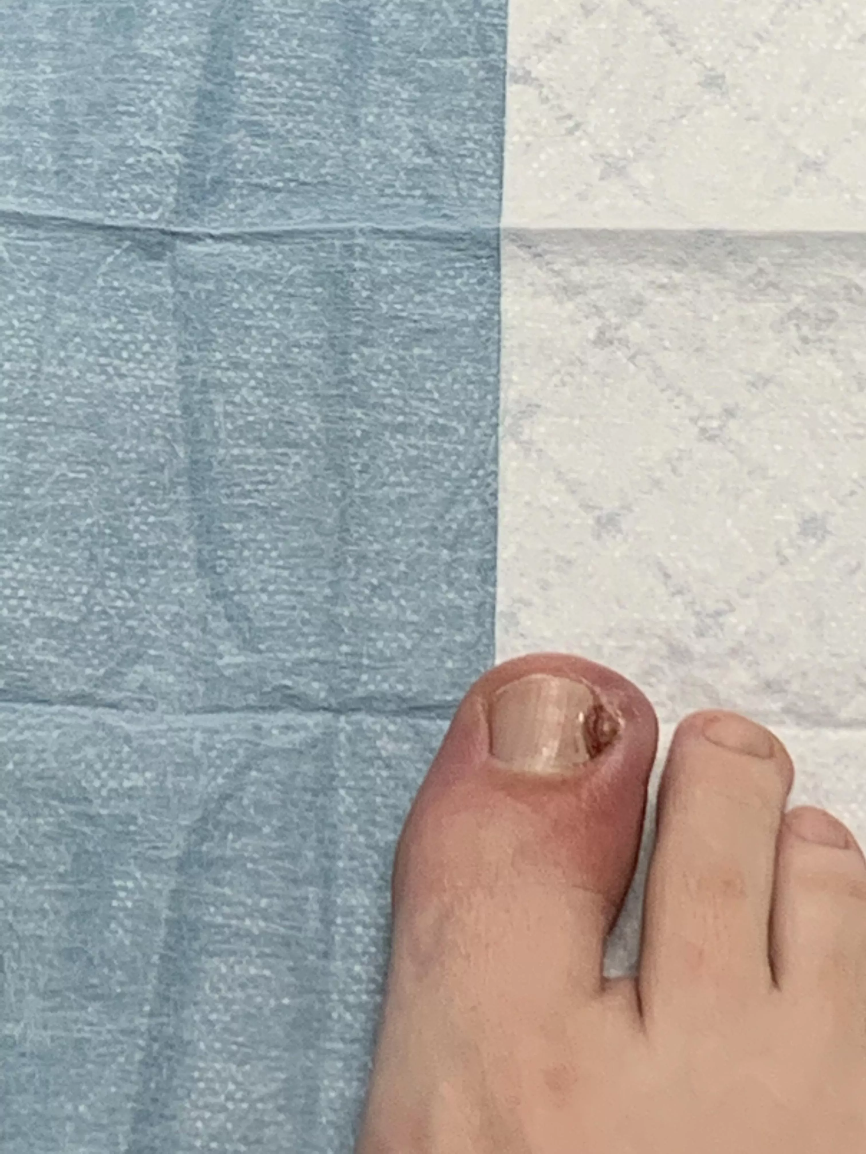 Ingrown toenail with staph posted by shayaceleste