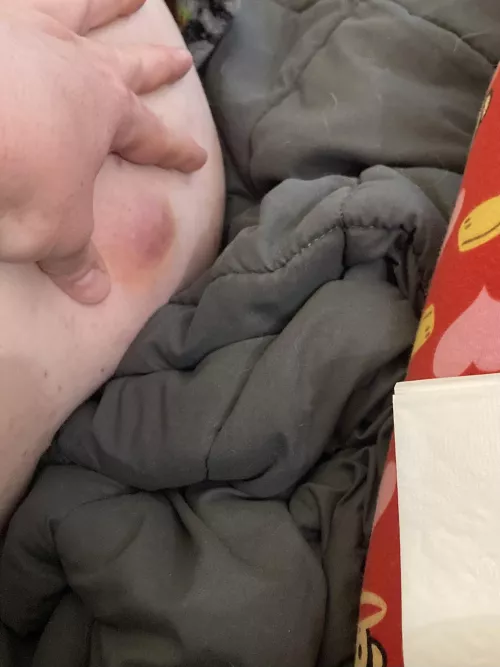 A bump on my hubs behind OC by False_Ad_4117