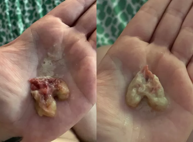 Birthed (coughed) out this mucus ball after being sick for 5 weeks and now I can BREATHE! by lilachub