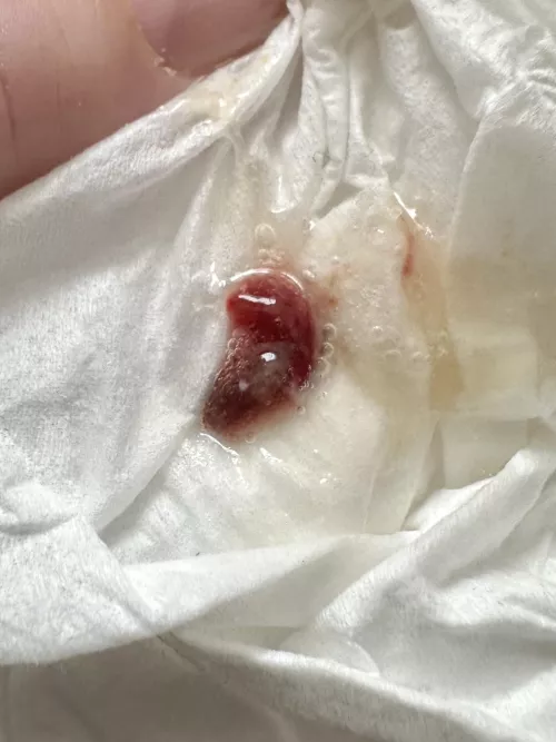 Coughed this up when I had pneumonia by BBYarbs