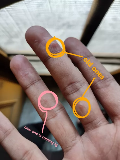 This myxoid cyst is growing by half_blood_073