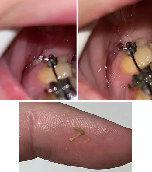 Before and after of a bone fragment that finally made its way out of my jaw from surgery 4 months ago by kawaiifie