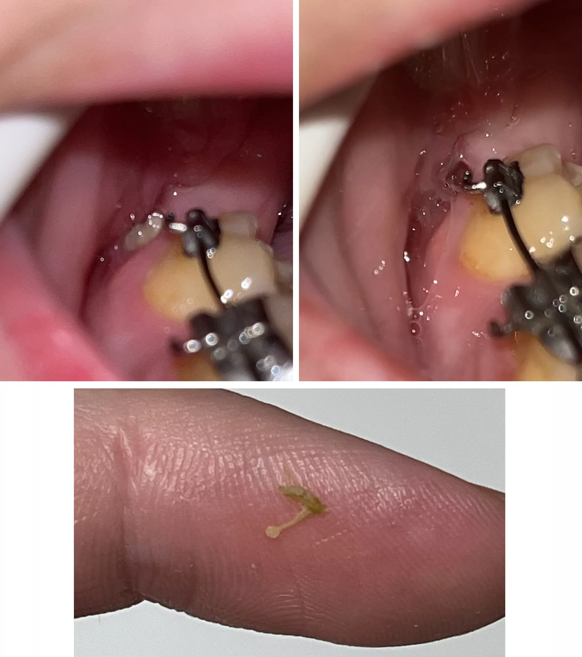 Before and after of a bone fragment that finally made its way out of my jaw from surgery 4 months ago posted by kawaiifie
