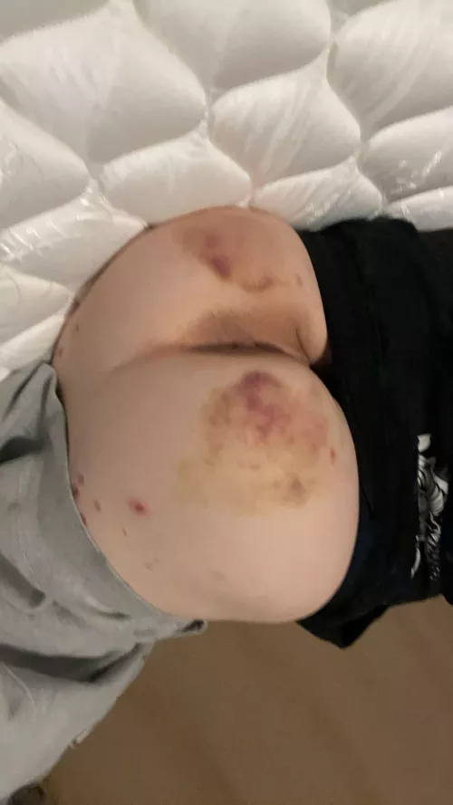 Markings update, just a few days later. Daddy kisses it every night by Ffaithhartt