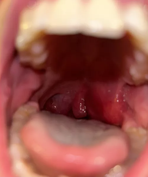 Quinsy before it burst at home. Extremely painful and scary. by Minute_Tomatillo_399