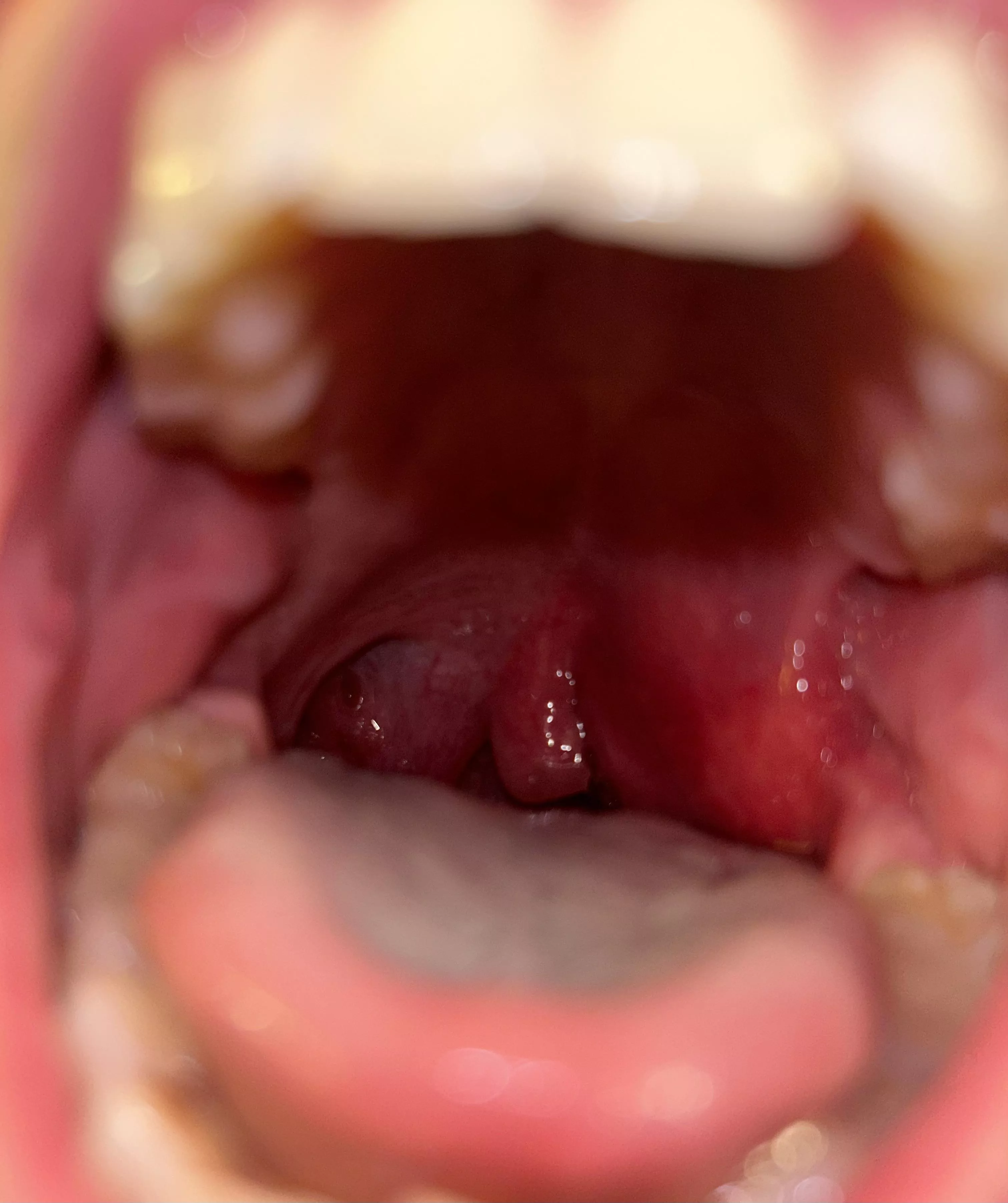 Quinsy before it burst at home. Extremely painful and scary. posted by Minute_Tomatillo_399