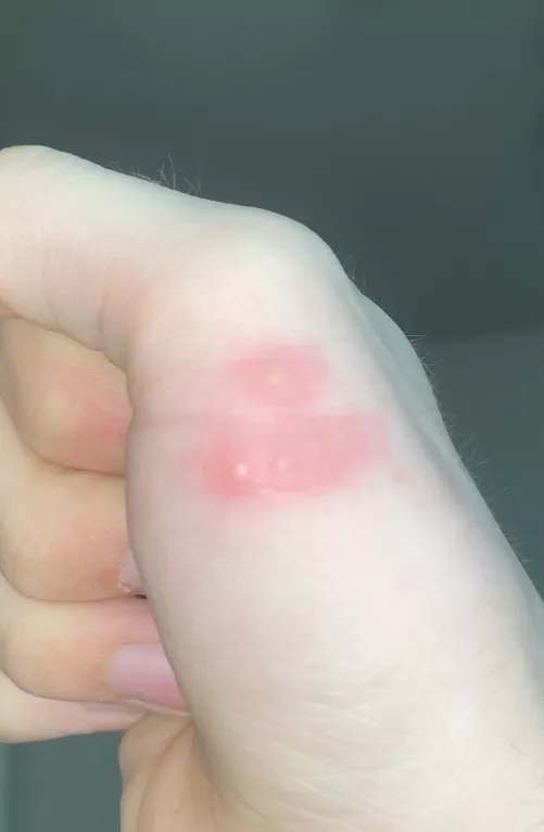 Are these pimples? Idk if they are and idk if I should pop them? by VI_Comet