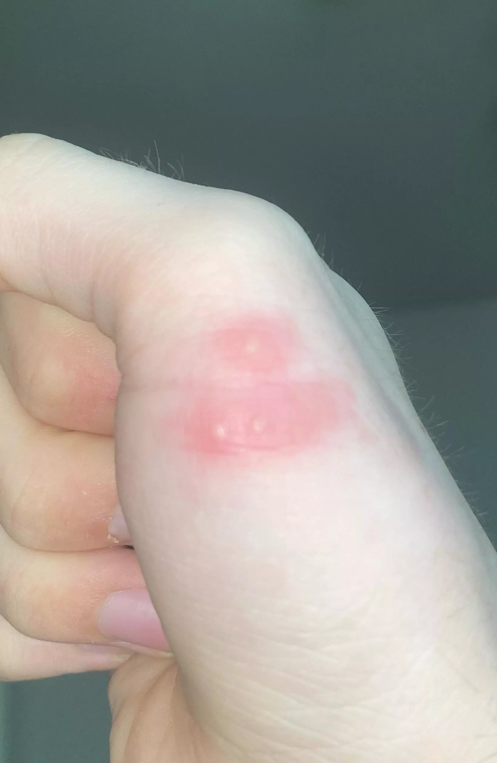 Are these pimples? Idk if they are and idk if I should pop them? posted by VI_Comet