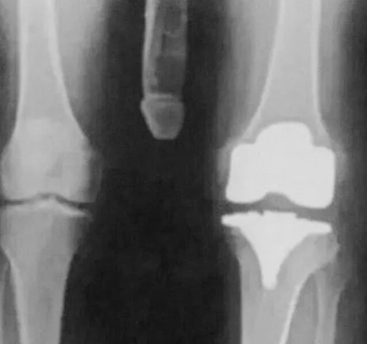 Knee surgery is healing up nicely by EdStArFiSh69