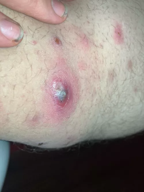 Pt3 innner thigh pimple by Dramatic_Homework100