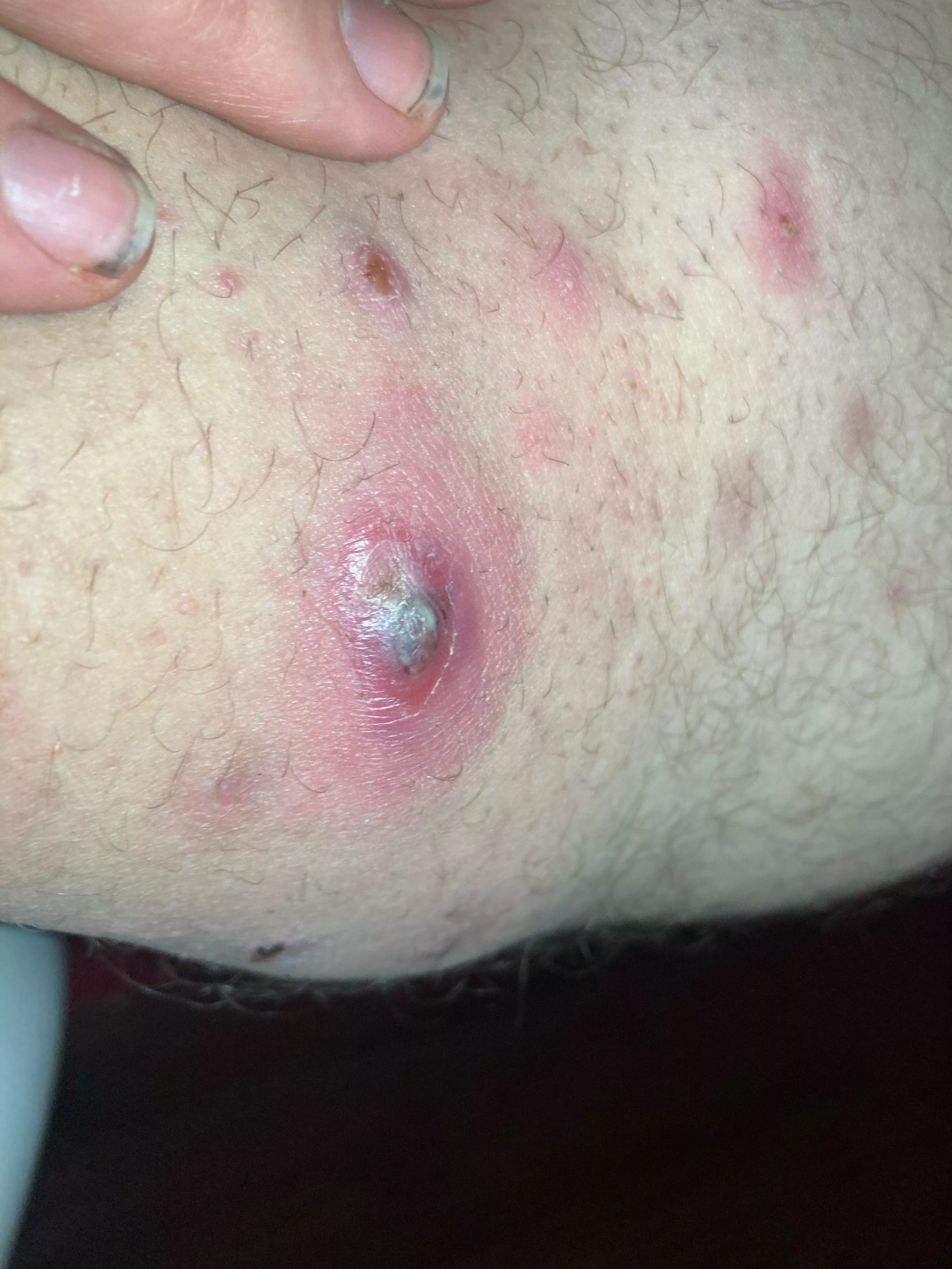 Pt3 innner thigh pimple posted by Dramatic_Homework100