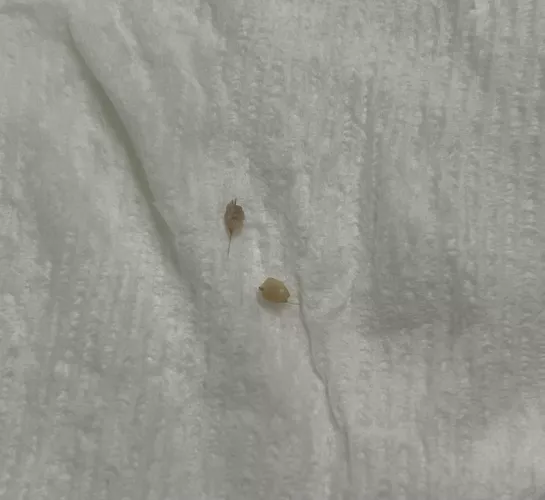 After 4 months of having these two painful small bumps on each of my buttcheeks, I am free by Round-Huckleberry-88