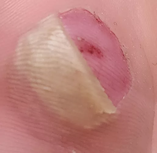 Blister skin flap is folded under the one on top by diethefIu