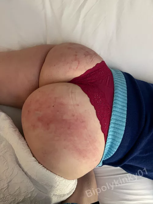 Could use some tender kisses after the spanking I just received by bipolykinky01
