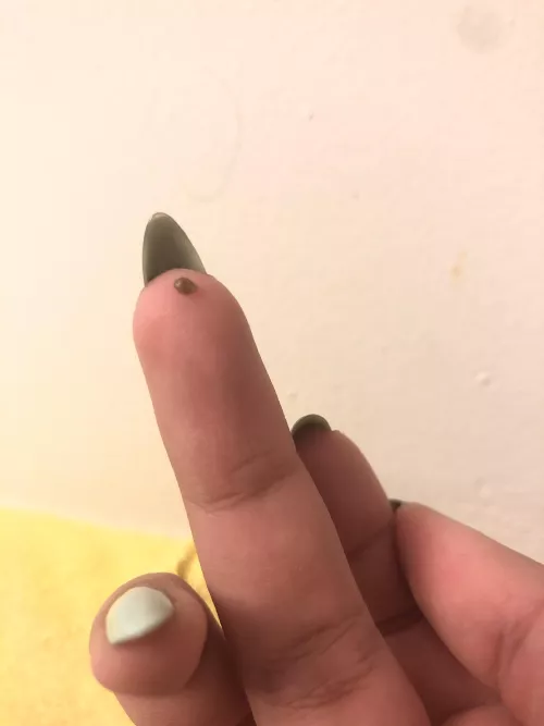 Sesame sized blackhead removed from my buttcheek by MxKtf