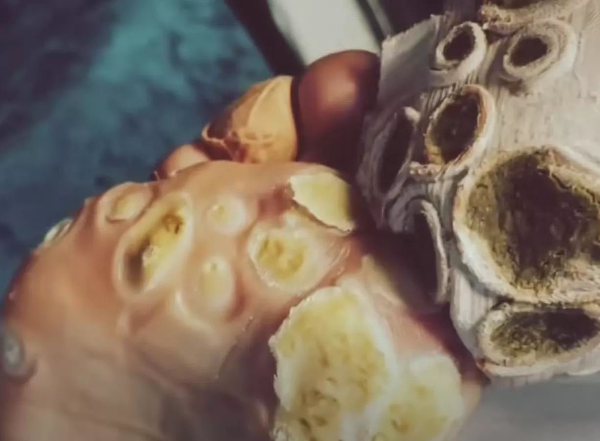 Another plantar wart one for WW - why is he not wearing gloves?! 😱 posted by Delicious-College8