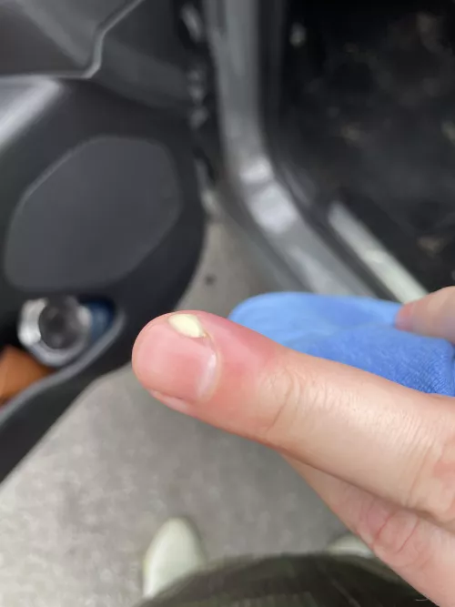 Yoinked a hangnail and it got infected by Chief_Slapaho69