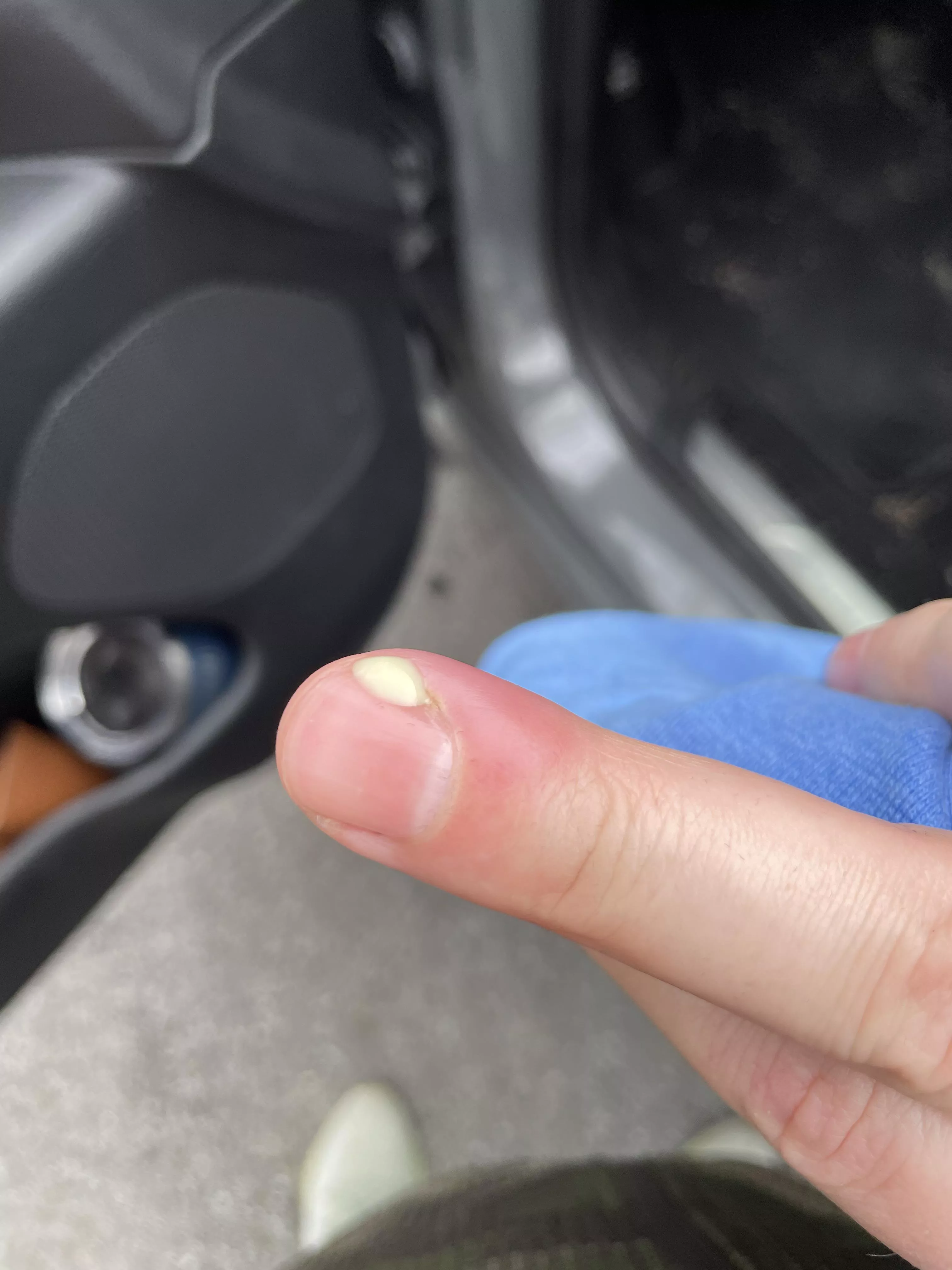 Yoinked a hangnail and it got infected posted by Chief_Slapaho69