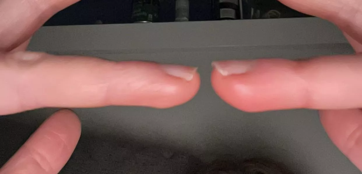 finger swelling - no injury prior? posted by No-Store-9901