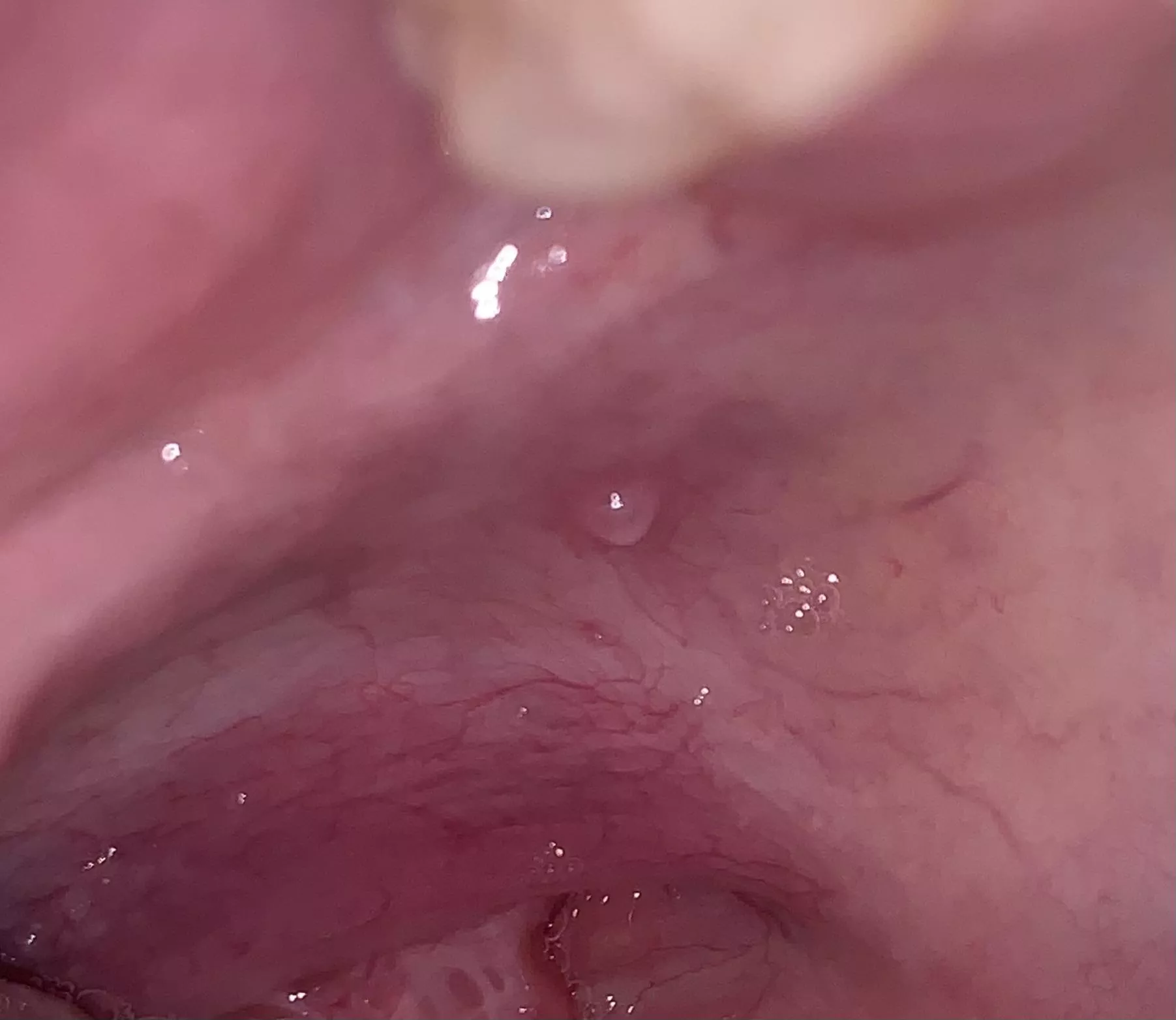 mucocele on the roof of my mouth (forbidden pop) posted by Salty-Shiba