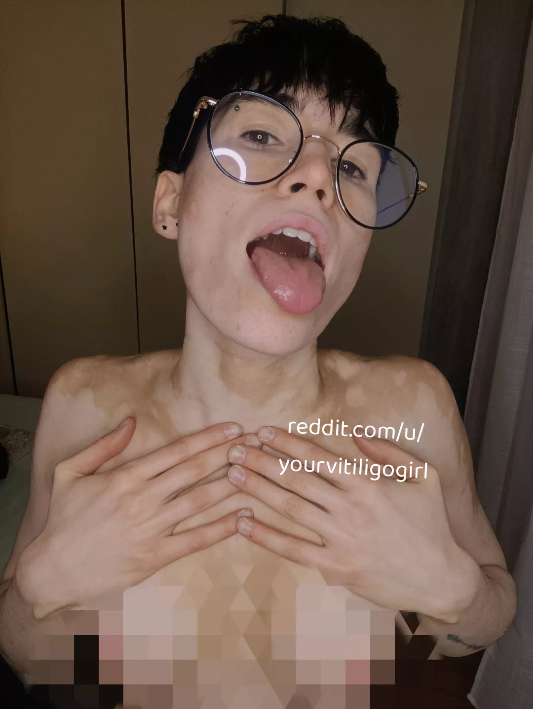 You know what to do.. posted by yourvitiligogirl