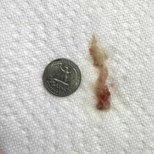 Sneezed huge nasal mucus plug. Been sick for days, such a relief to breathe again by Art-Hoe_pdf